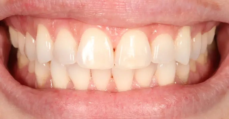 After the cleaning: the same teeth, clean and polished, without the tartar and stains