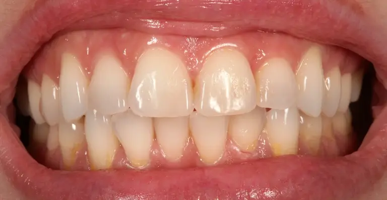 Before the cleaning: front teeth with tartar and yellow-brown stains along the gumline of the lower teeth